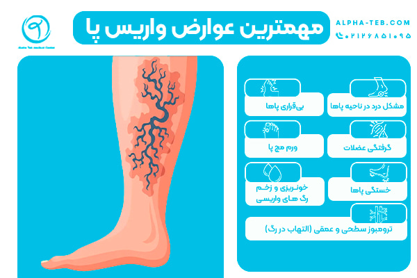 عوارض واریس پا چیست؟