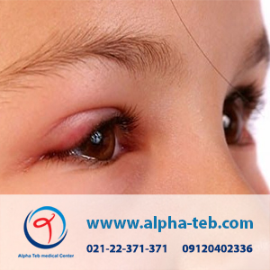 عفونت چشمی در کودکان و درمان آن