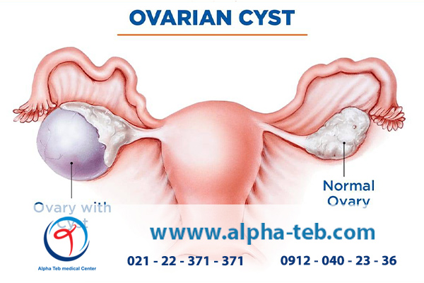 علائم کیست تخمدان از کوچک تا بزرگ