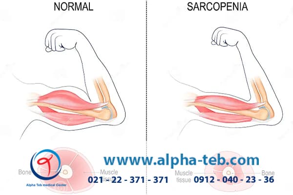 سارکوپنی چیست؟