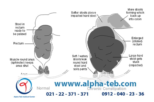 یبوست مزمن و تأثیر آن بر بی‌اختیاری مدفوع