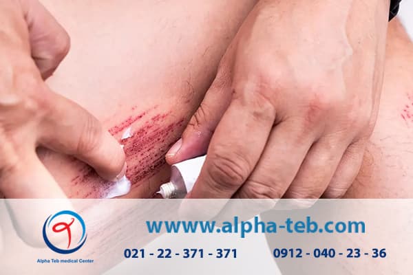روش های پیشگیری از زخم بستر