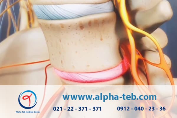 چه زمانی بیرون‌زدگی دیسک کمر نیاز به جراحی دارد؟