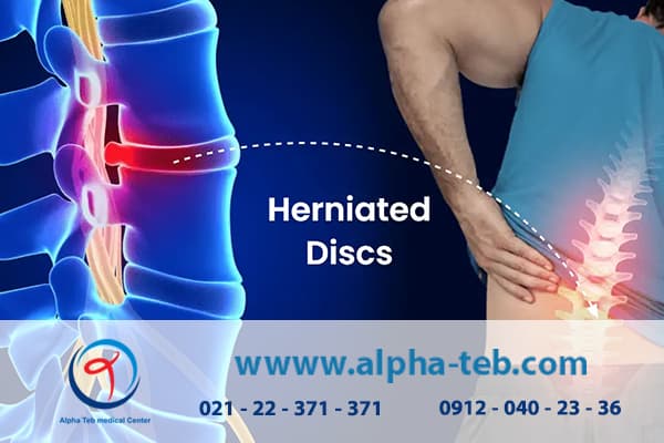 بیرون‌زدگی دیسک کمر چیست و چرا اتفاق می‌افتد؟