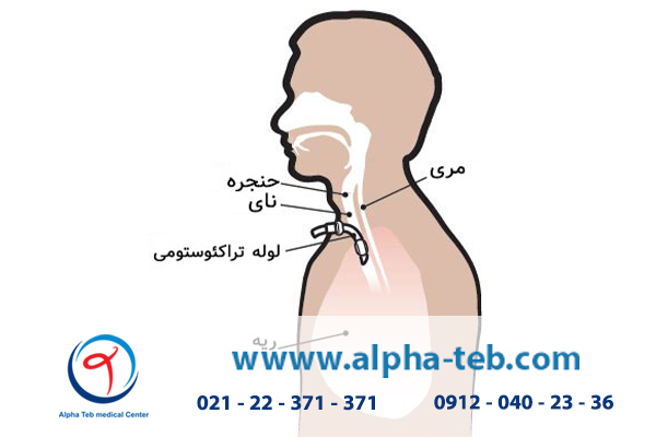 مراقبت از بیمار تراکئوستومی در منزل