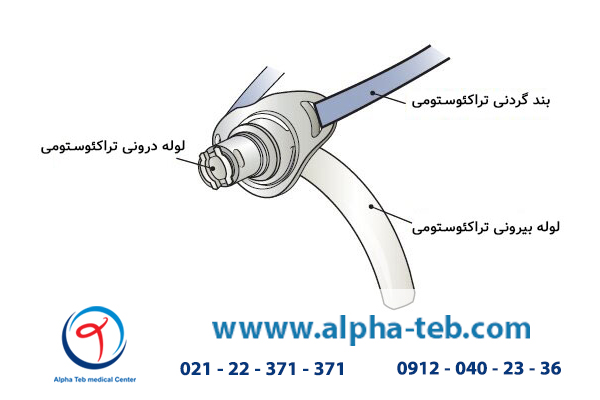 مراقبت از بیمار تراکئوستومی در منزل
