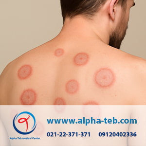 قارچ پوستی یا درماتوسیسز