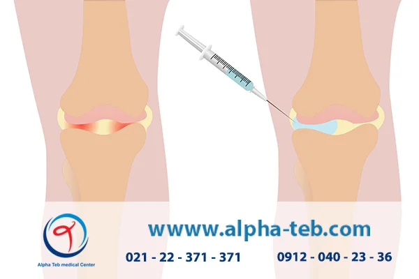 بهترین ژل برای تزریق زانو